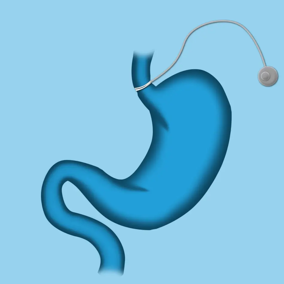 Gastric Band