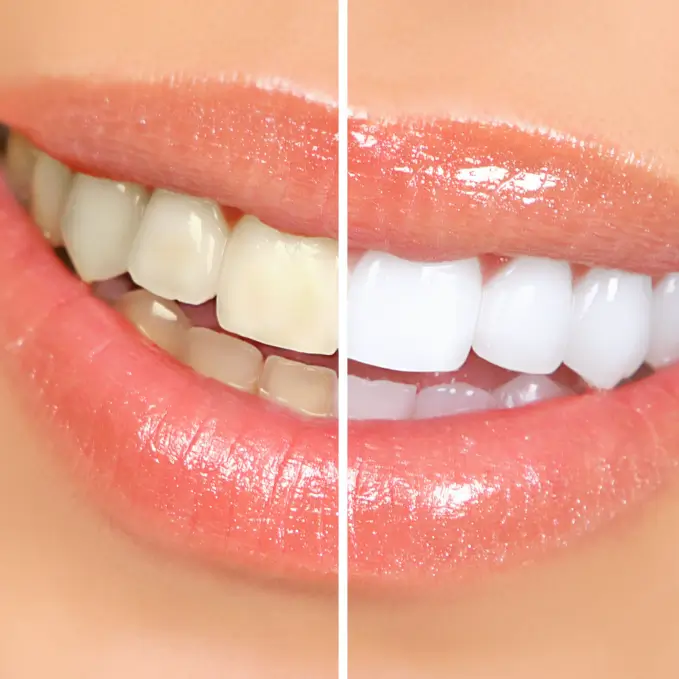 Teeth Whitening