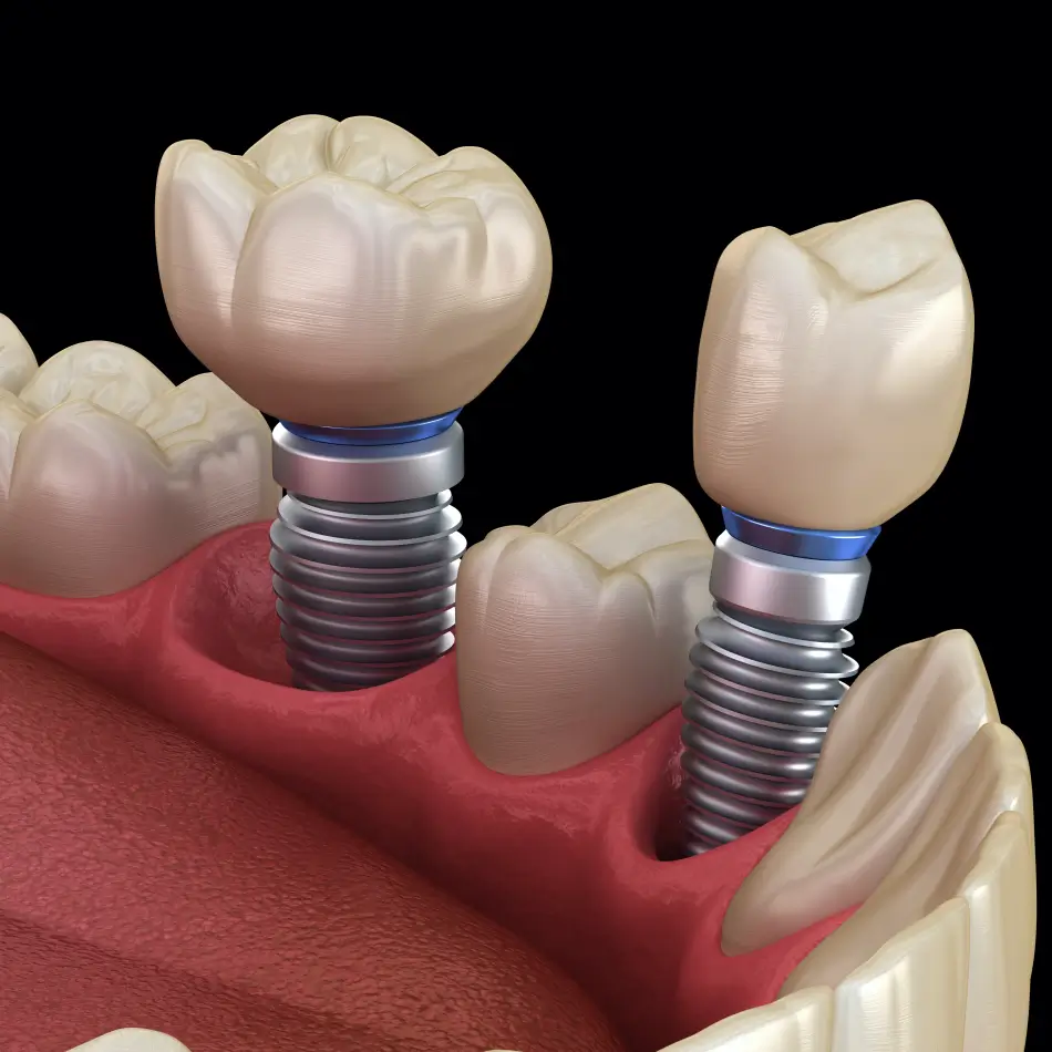 Dental Implants